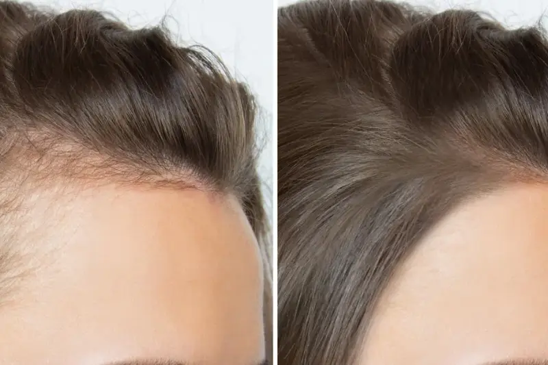 Effective Hair Fall Treatments