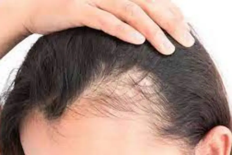 Blood Test for Hair Loss