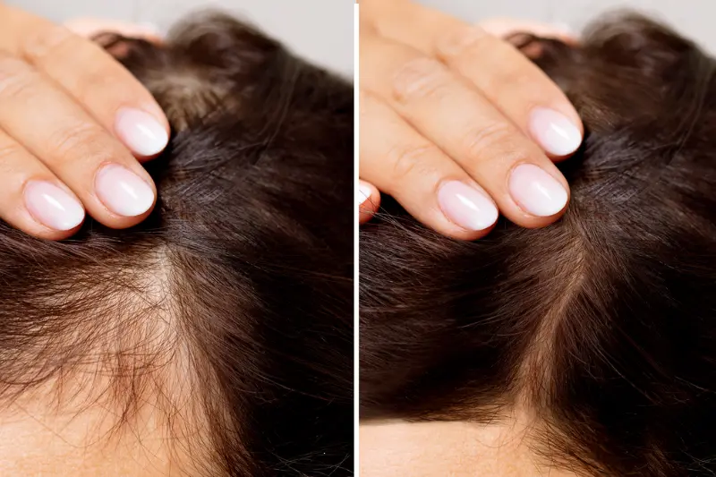 Solutions for Bald Hair (bald hair solution)